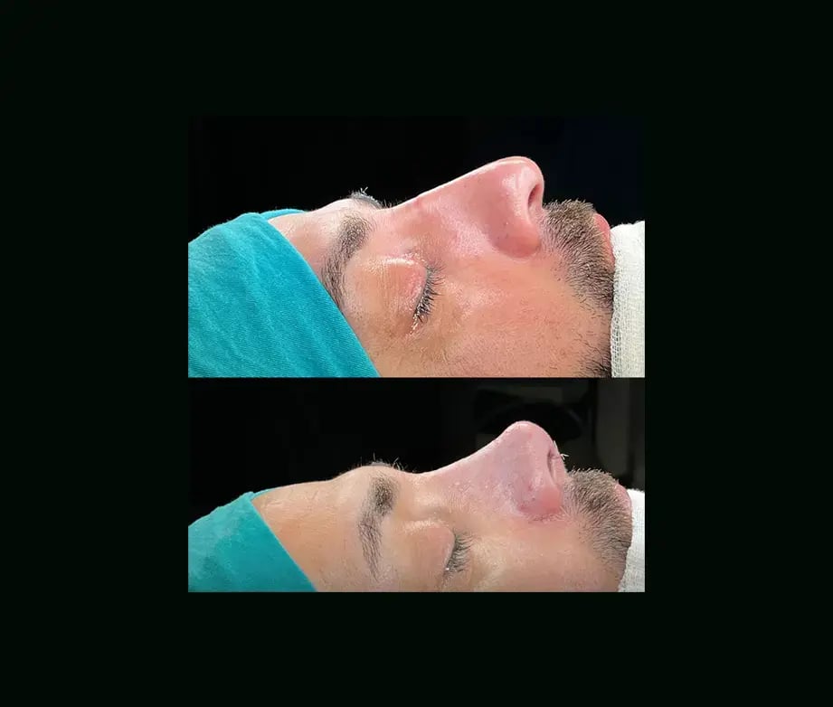 cenk-teker-md-rhinoplasty-before-after-24