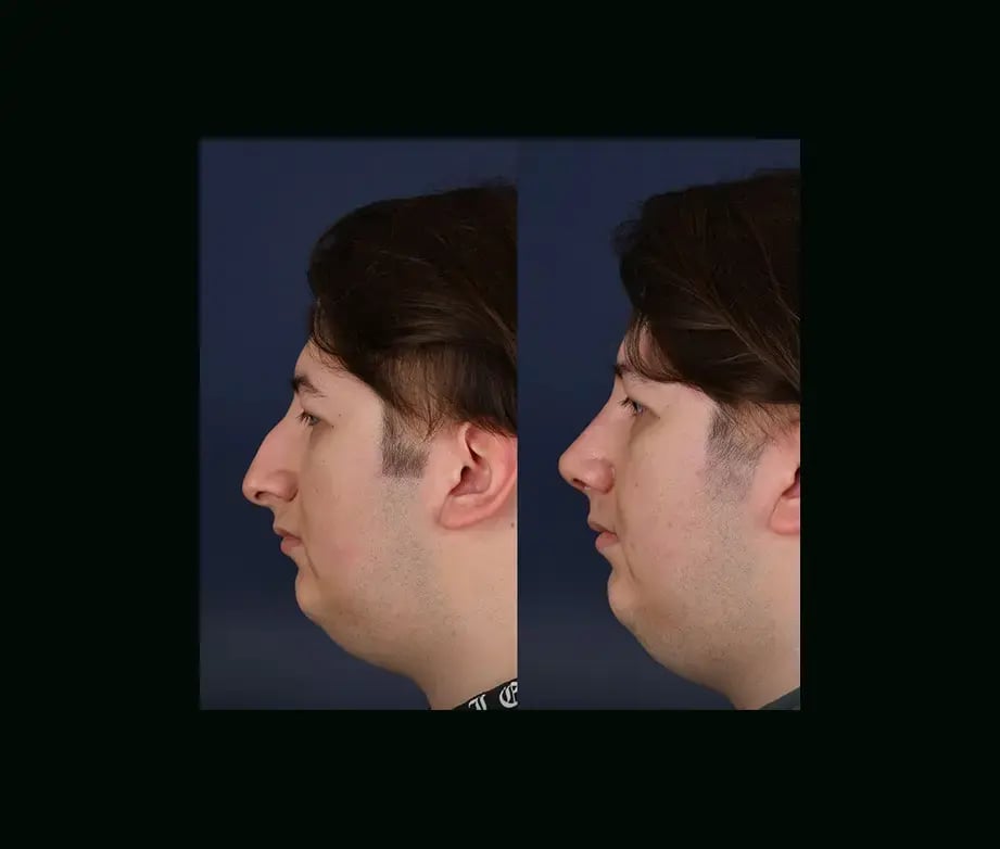 cenk-teker-md-rhinoplasty-before-after-25