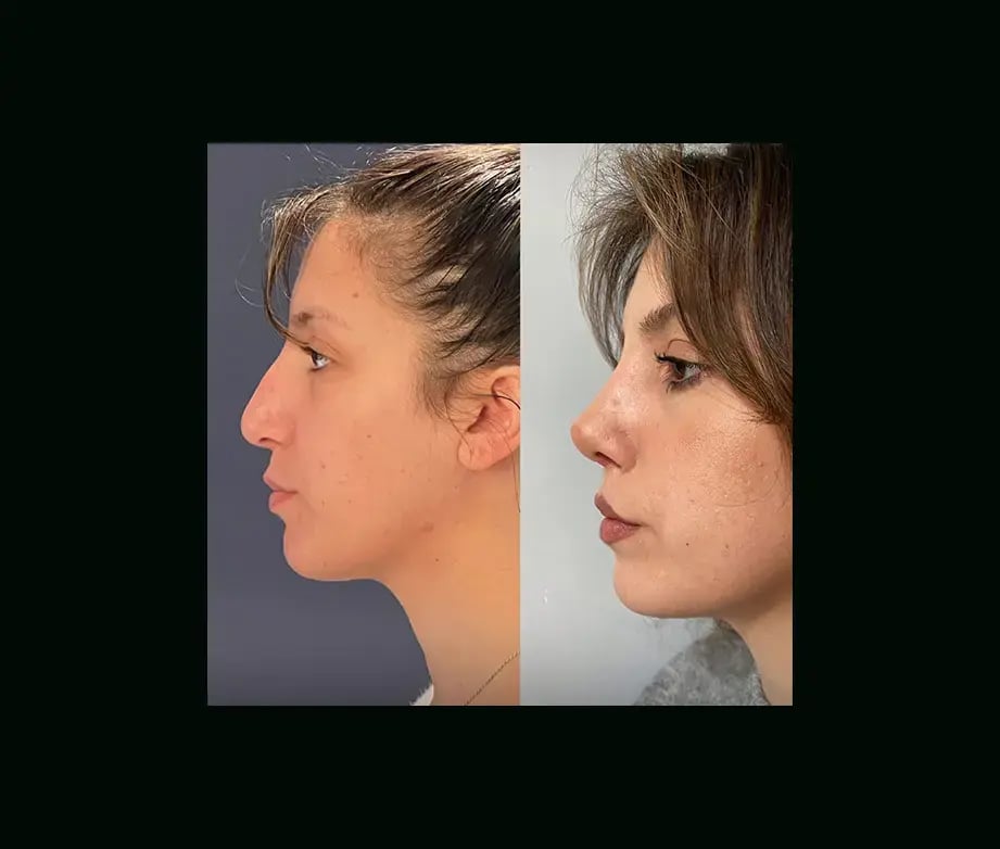 cenk-teker-md-rhinoplasty-before-after-26