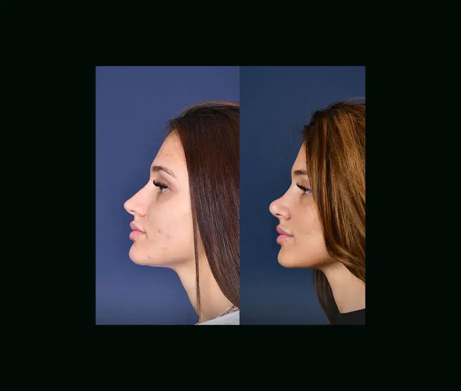 cenk-teker-md-rhinoplasty-before-after-27-1