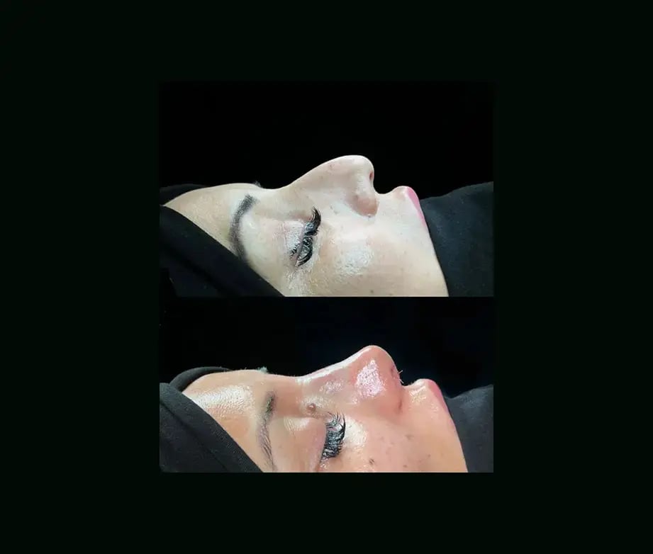 cenk-teker-md-rhinoplasty-before-after-28
