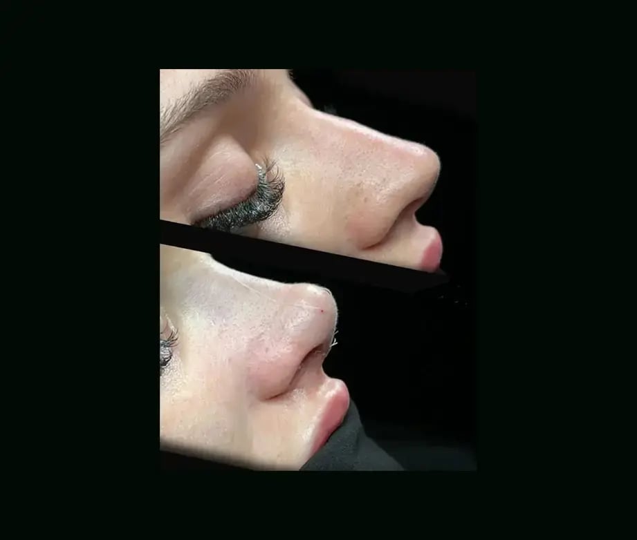 cenk-teker-md-rhinoplasty-before-after-29