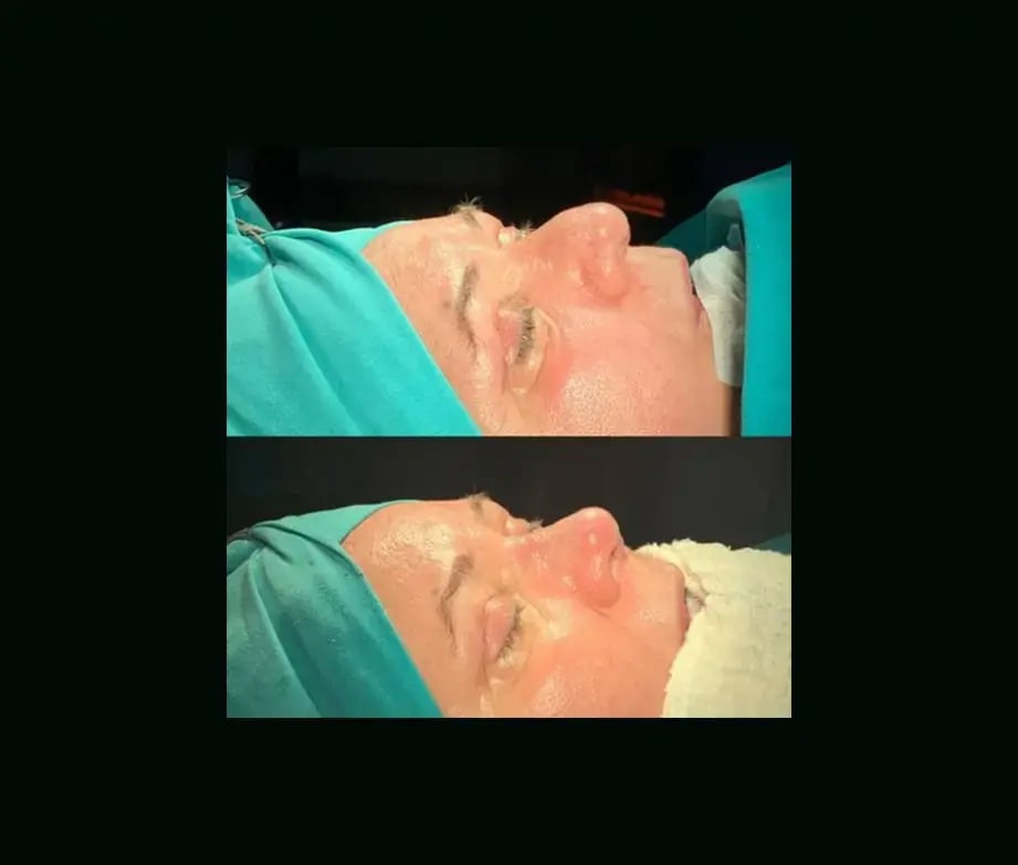 cenk-teker-md-rhinoplasty-before-after-3