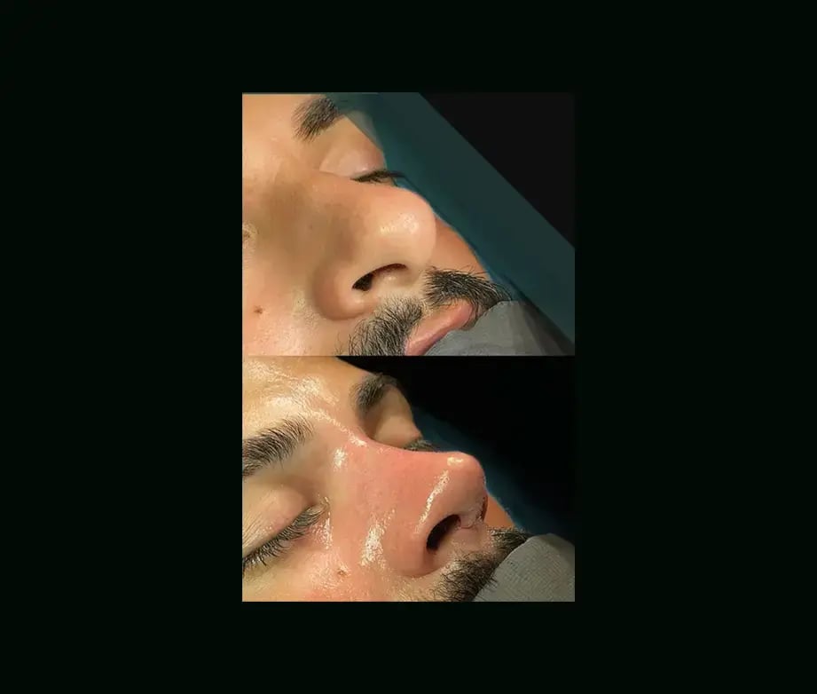 cenk-teker-md-rhinoplasty-before-after-30