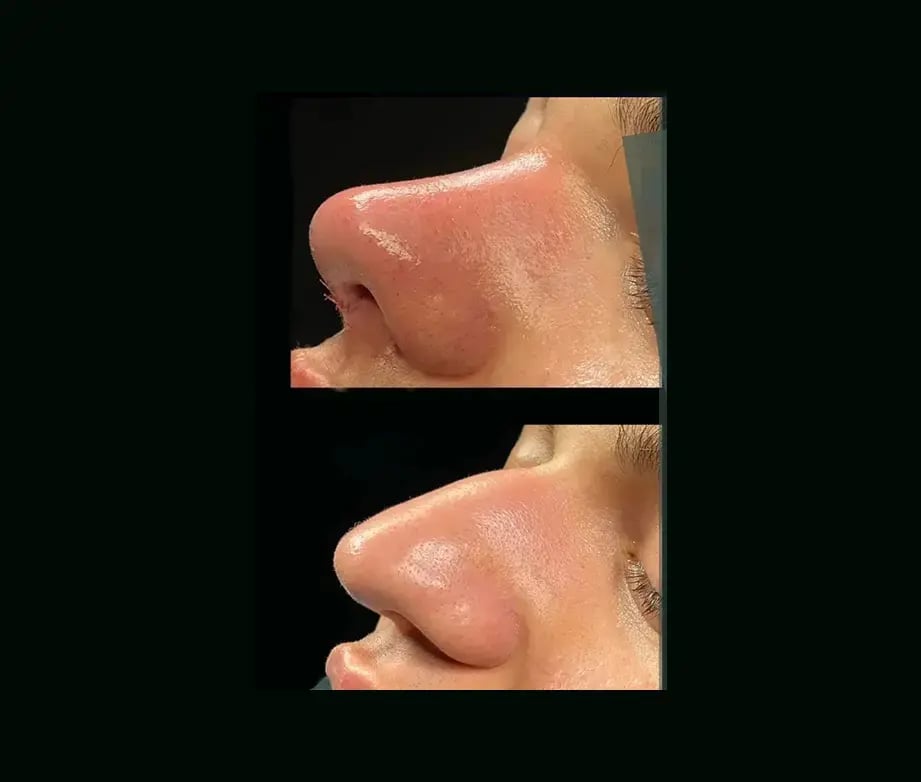 cenk-teker-md-rhinoplasty-before-after-31-1