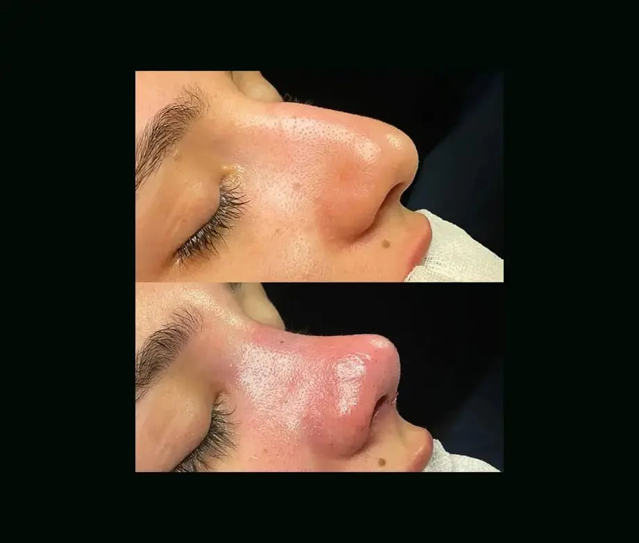 cenk-teker-md-rhinoplasty-before-after-32