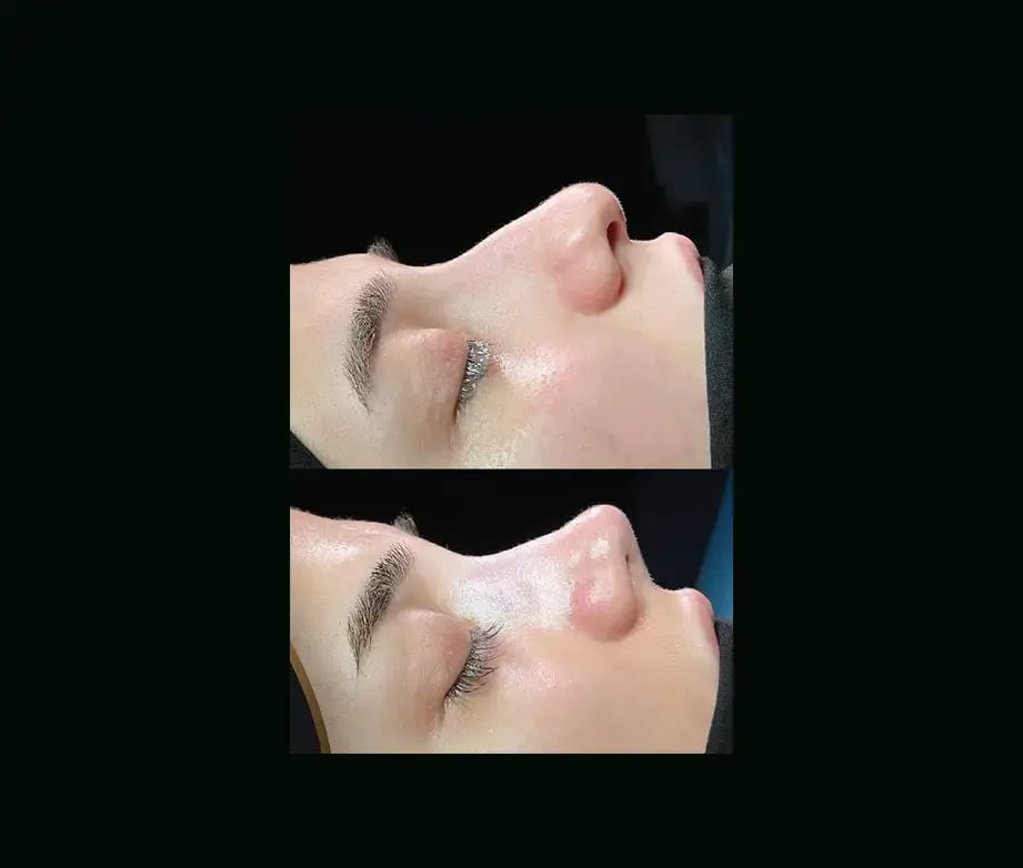 cenk-teker-md-rhinoplasty-before-after-34