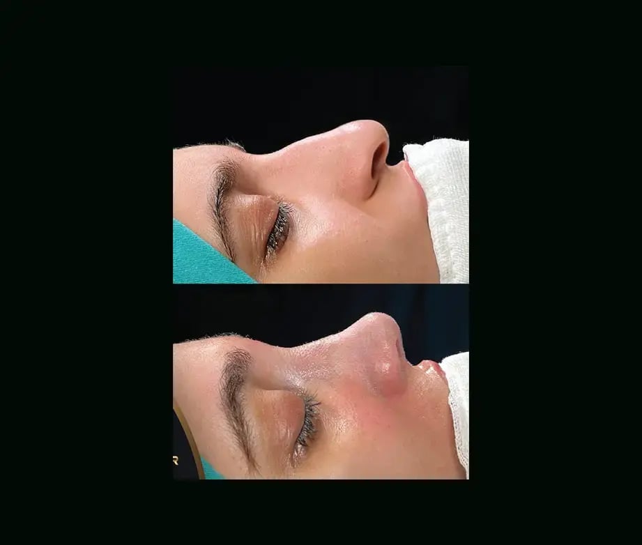 cenk-teker-md-rhinoplasty-before-after-35