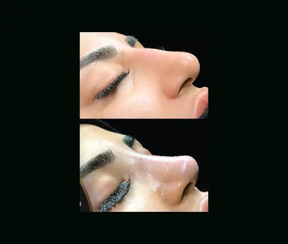 cenk-teker-md-rhinoplasty-before-after-36