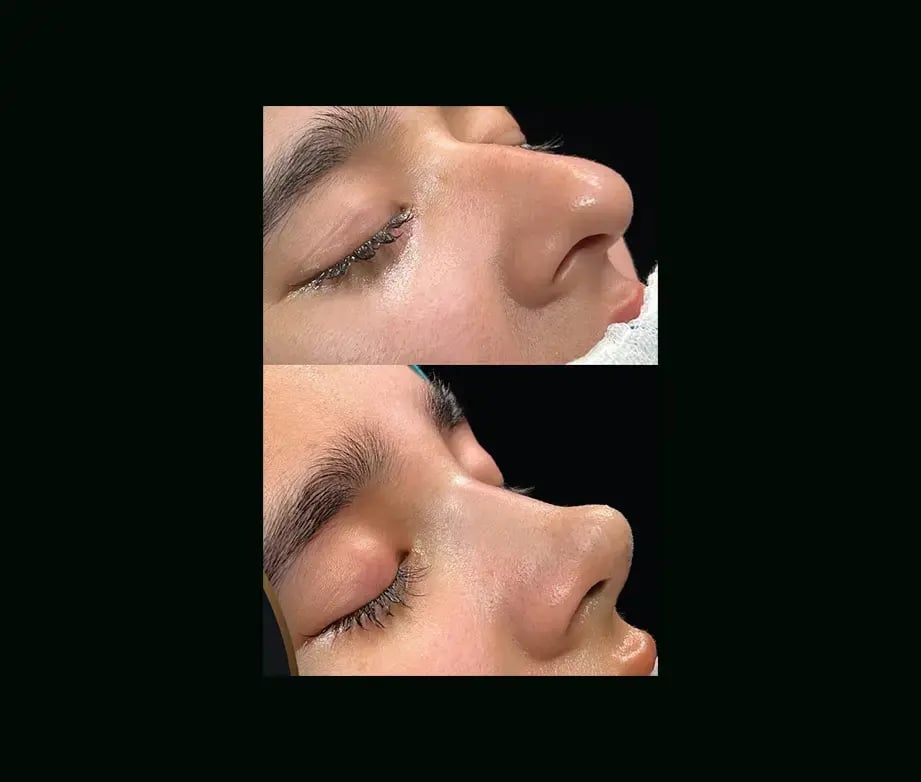 cenk-teker-md-rhinoplasty-before-after-37