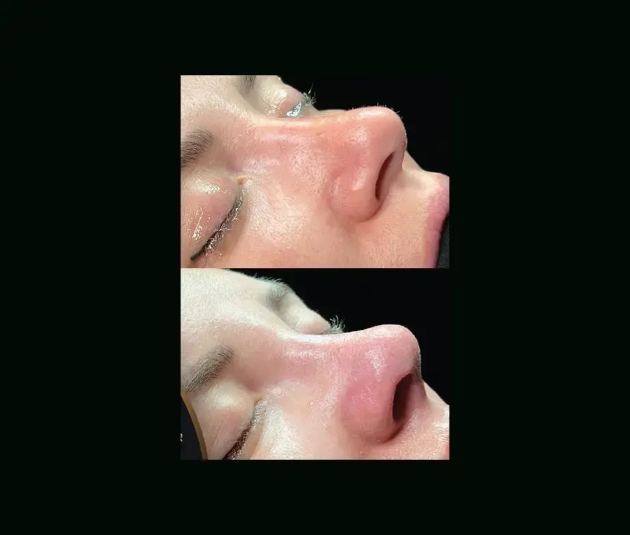 cenk-teker-md-rhinoplasty-before-after-38