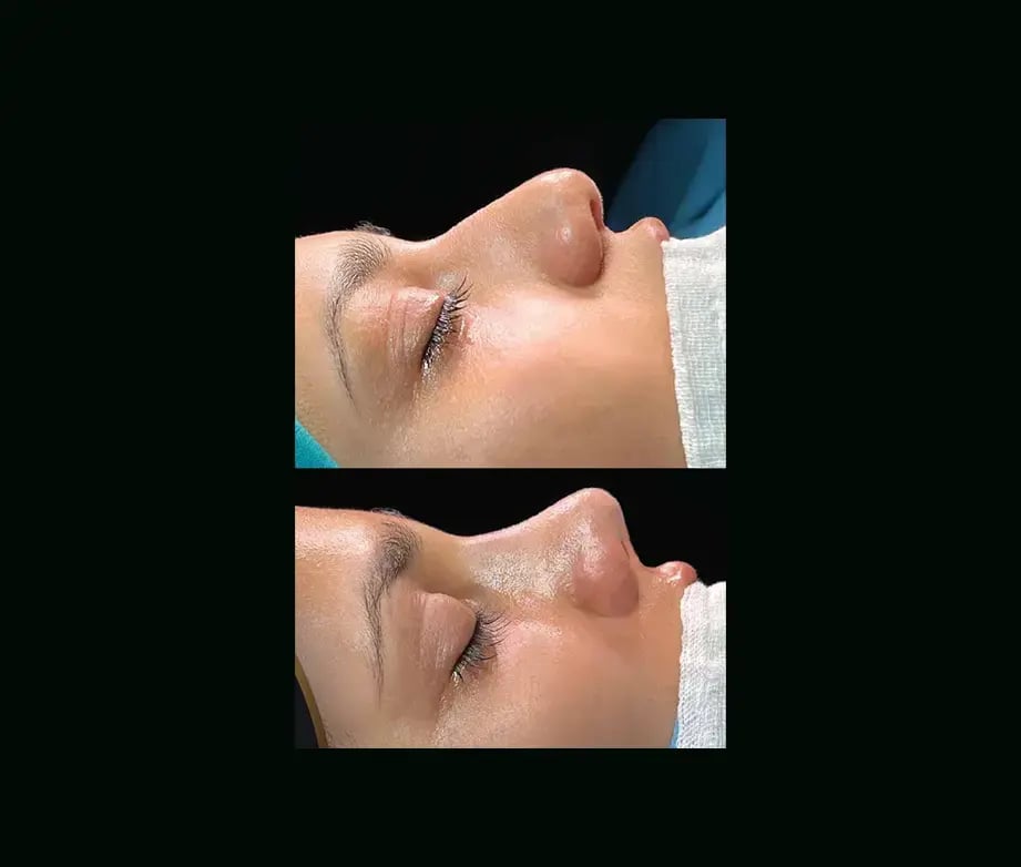cenk-teker-md-rhinoplasty-before-after-39