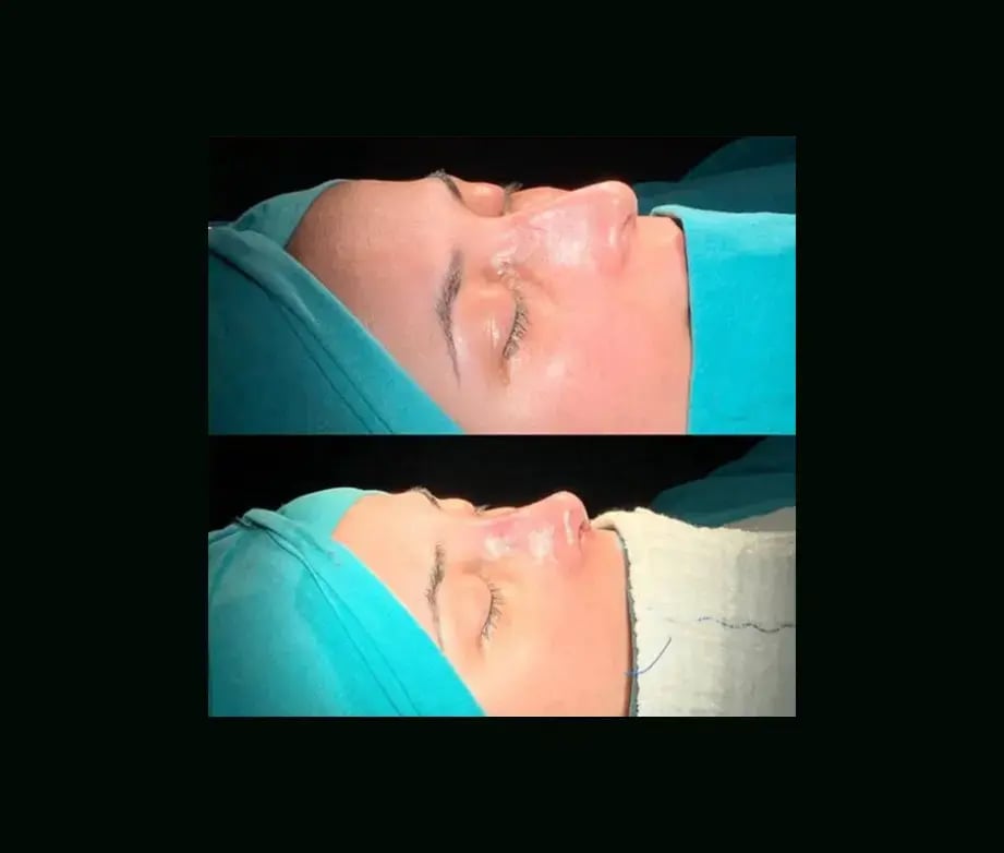 cenk-teker-md-rhinoplasty-before-after-4