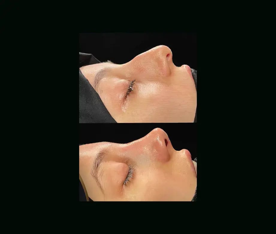cenk-teker-md-rhinoplasty-before-after-40