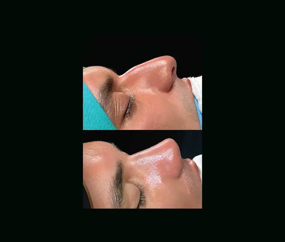 cenk-teker-md-rhinoplasty-before-after-41