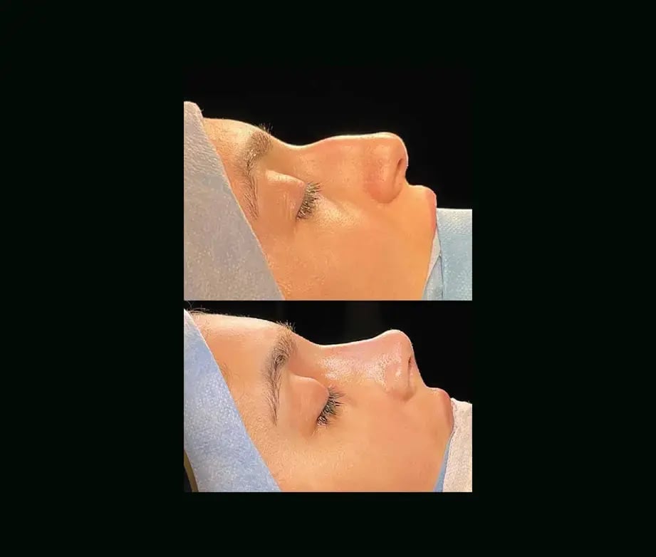 cenk-teker-md-rhinoplasty-before-after-42