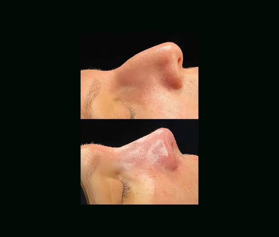 cenk-teker-md-rhinoplasty-before-after-43