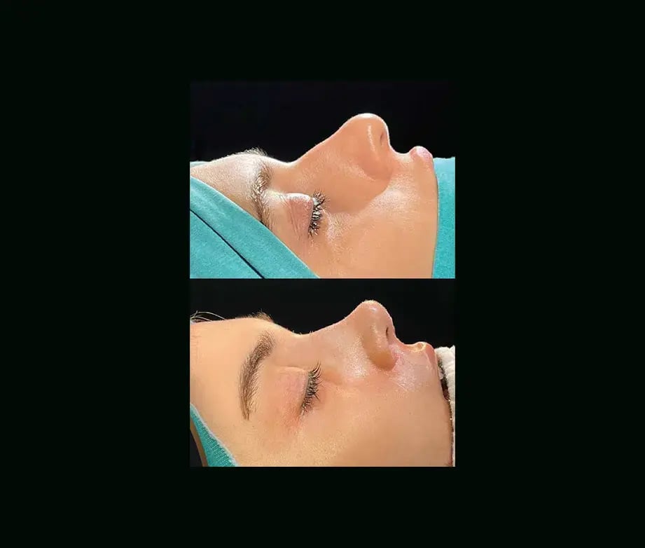 cenk-teker-md-rhinoplasty-before-after-44