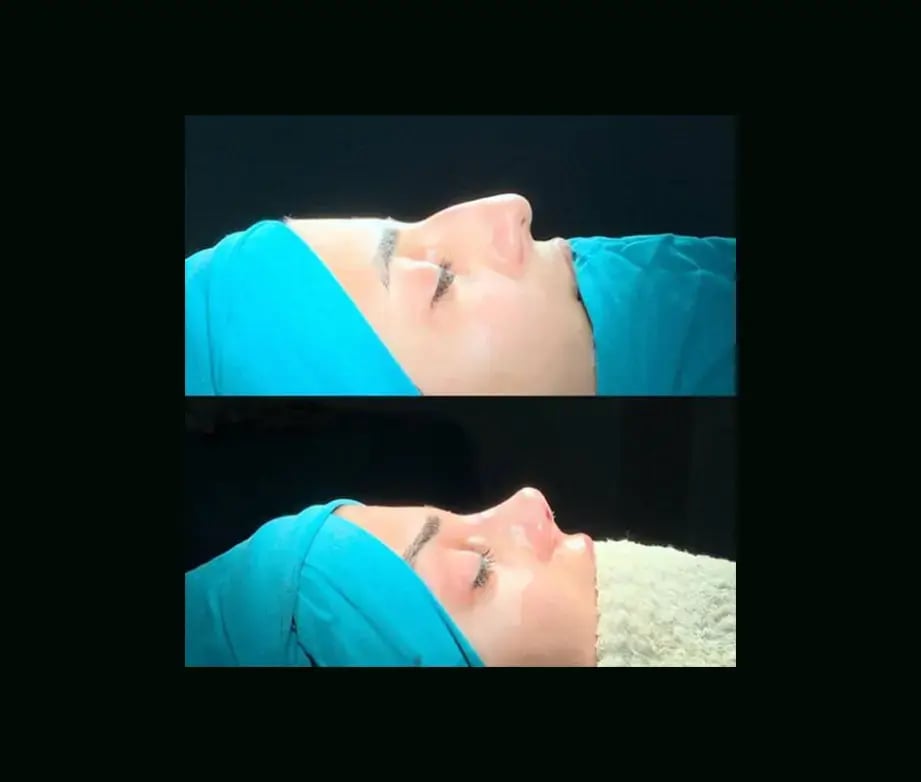 cenk-teker-md-rhinoplasty-before-after-5