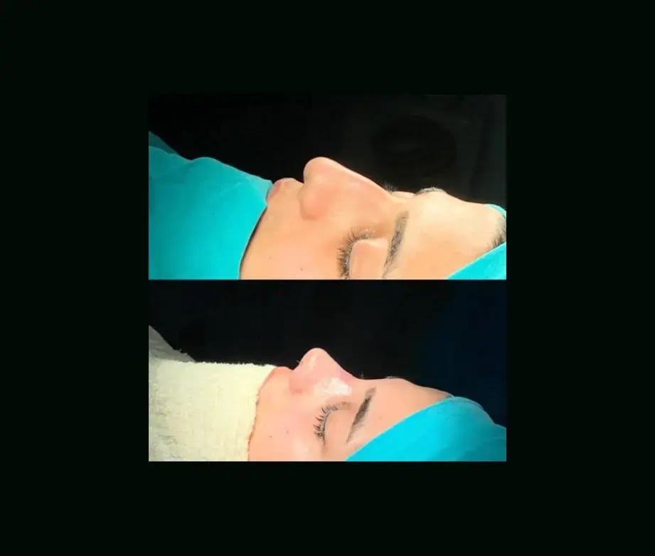 cenk-teker-md-rhinoplasty-before-after-6