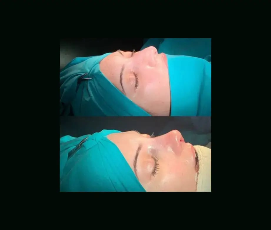 cenk-teker-md-rhinoplasty-before-after-7-1