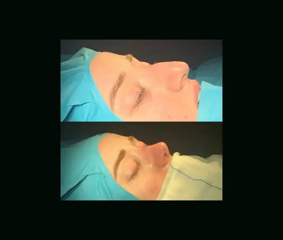 cenk-teker-md-rhinoplasty-before-after-8