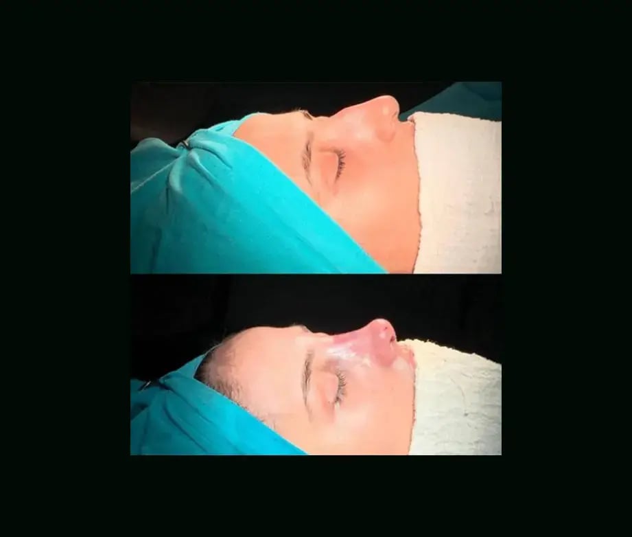 cenk-teker-md-rhinoplasty-before-after-9