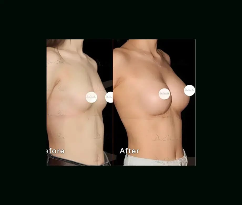 ebru-sen-md-breast-augmentation-before-after-1-1