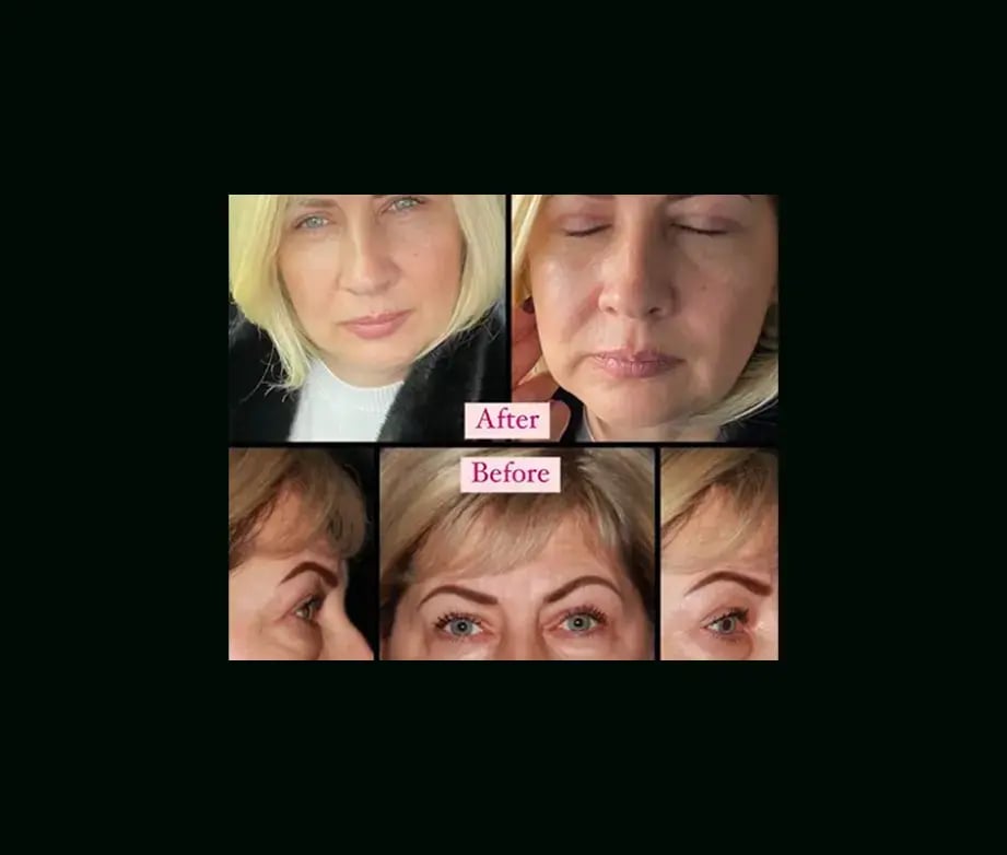 ebru-sen-md-eyelid-before-after-1-1