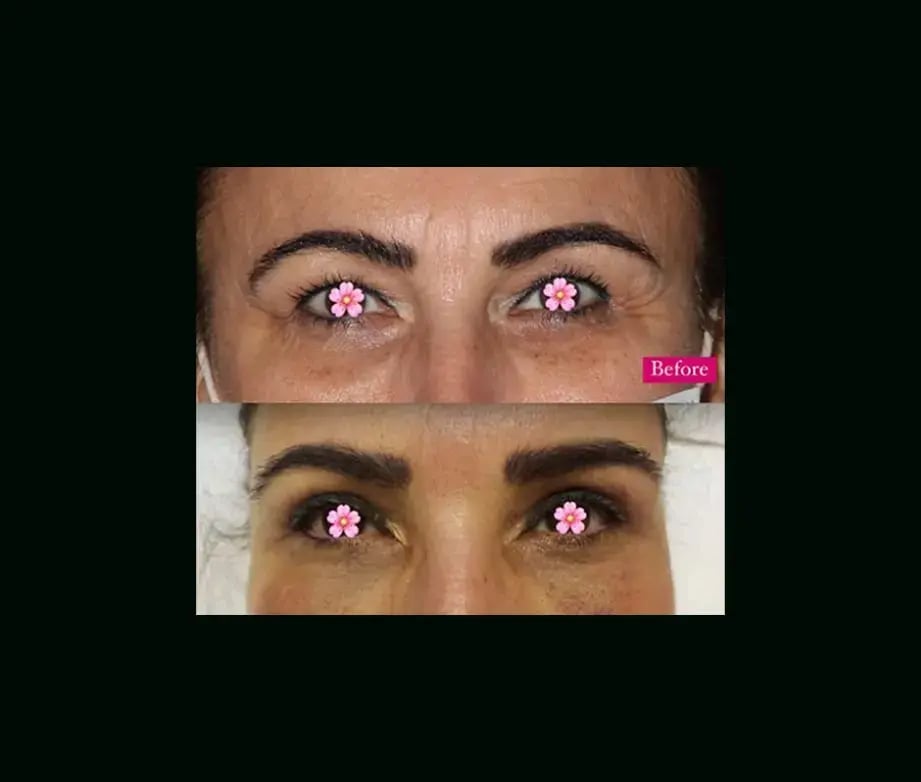 ebru-sen-md-eyelid-before-after-2-1