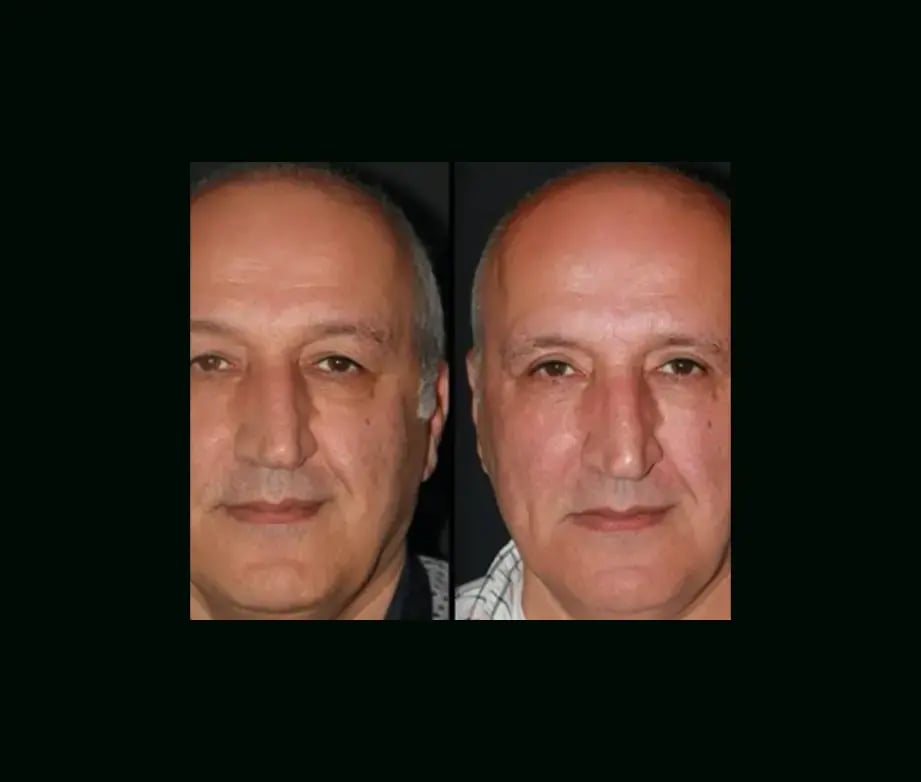 ebru-sen-md-eyelid-before-after-3-1