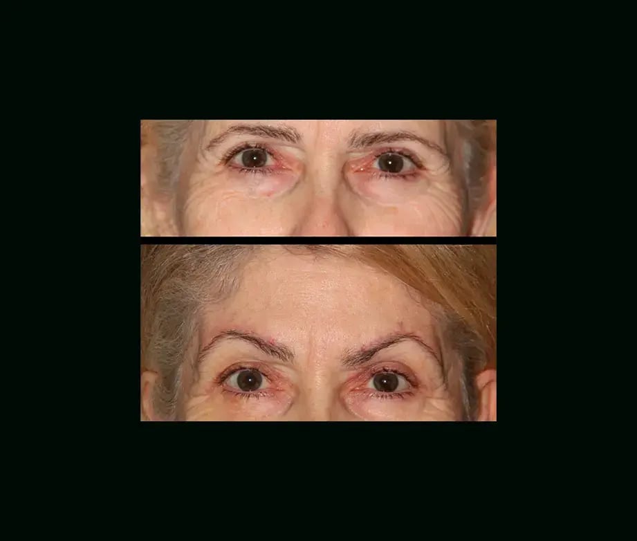 ebru-sen-md-eyelid-before-after-4-1