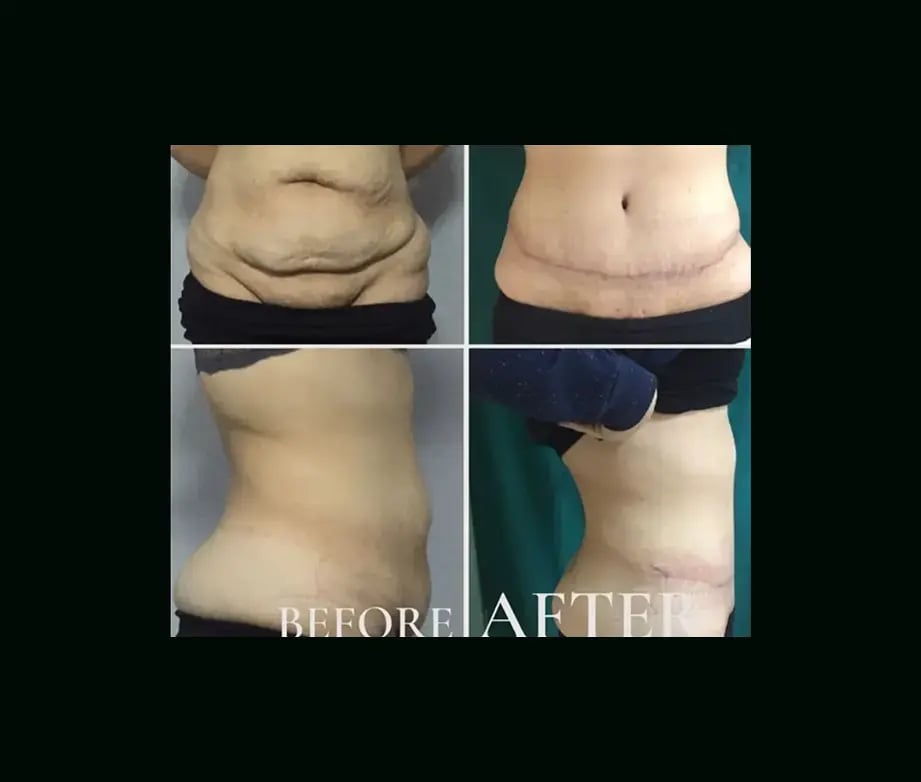 ebru-sen-md-tummy-tuck-before-after-4-2