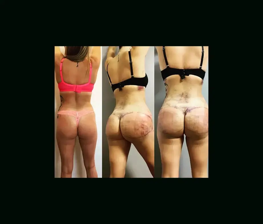 ekrem-keskin-md-bbl-before-after-5-1