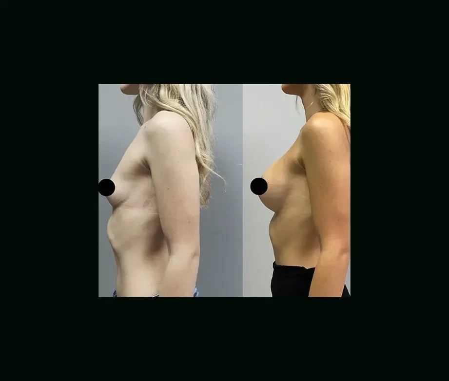 ekrem-keskin-md-breast-augmentation-before-after-2-1