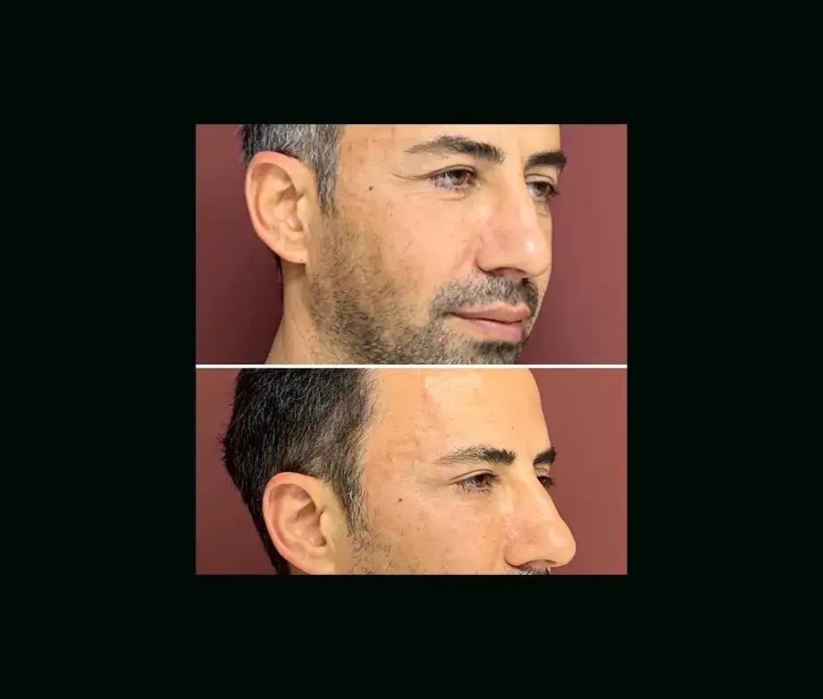 ekrem-keskin-md-eyelid-before-after-1-1