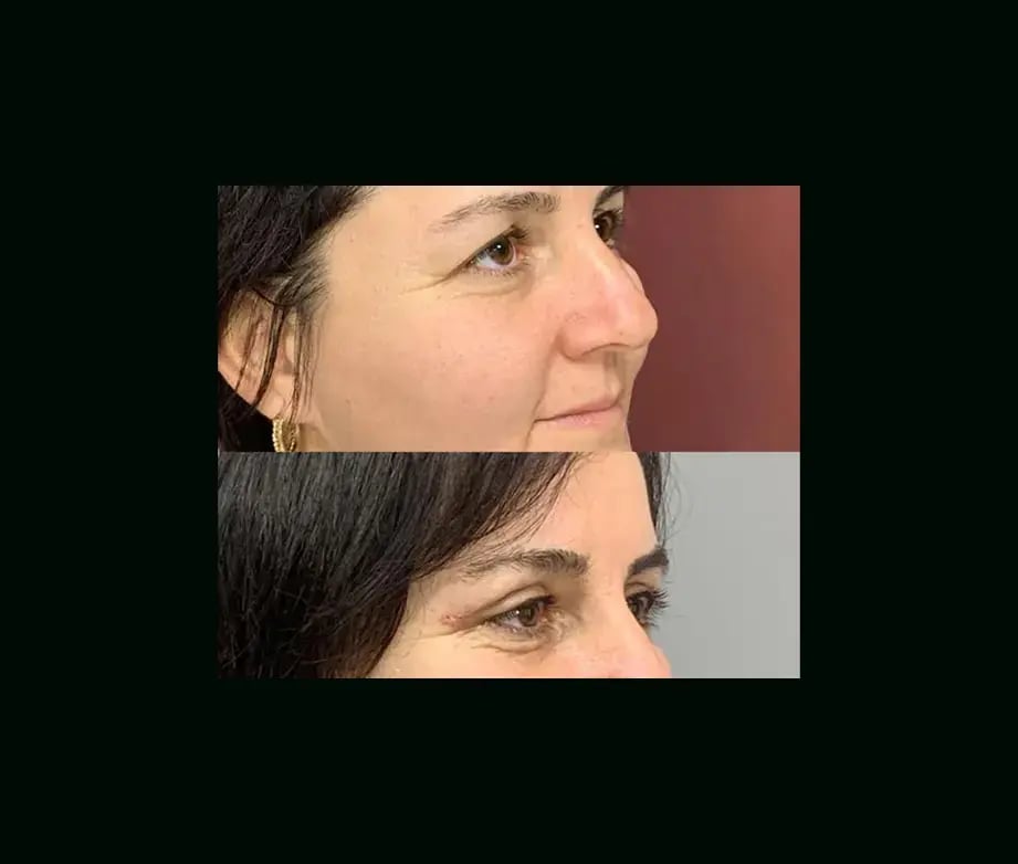 ekrem-keskin-md-eyelid-before-after-2-1