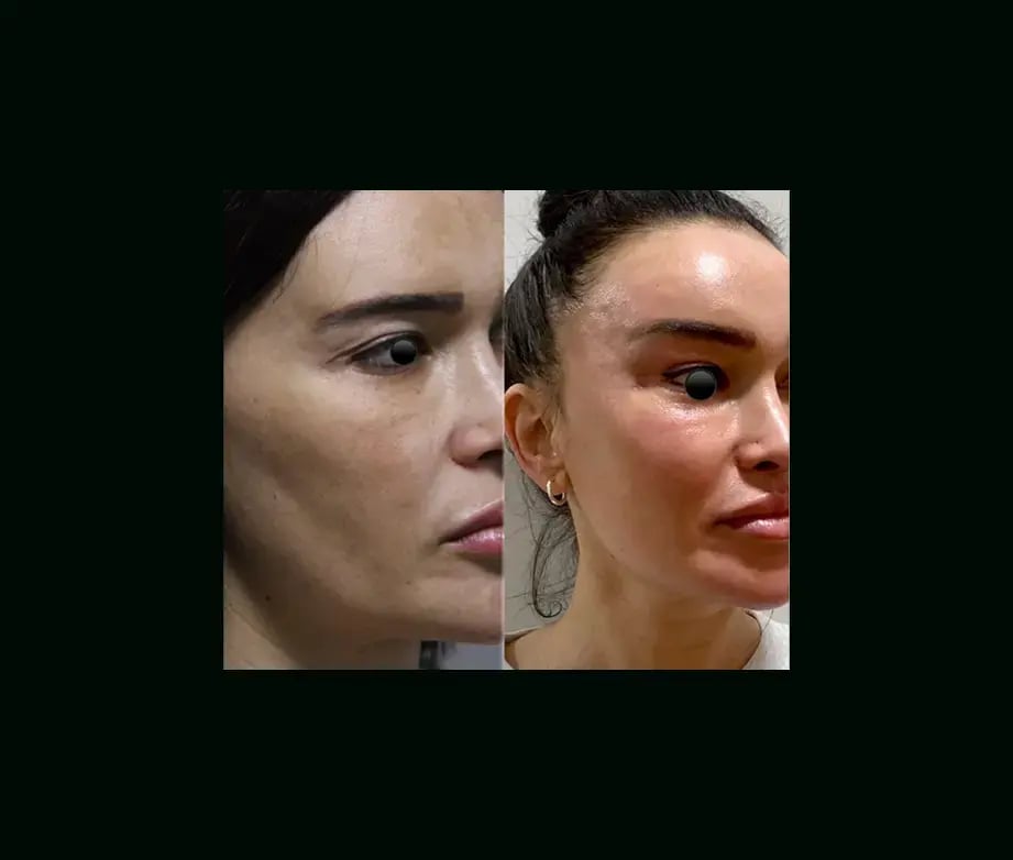 ekrem-keskin-md-eyelid-before-after-3-1