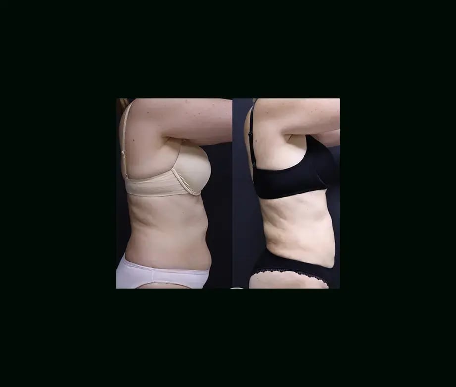 ekrem-keskin-md-liposuction-before-after-2-1
