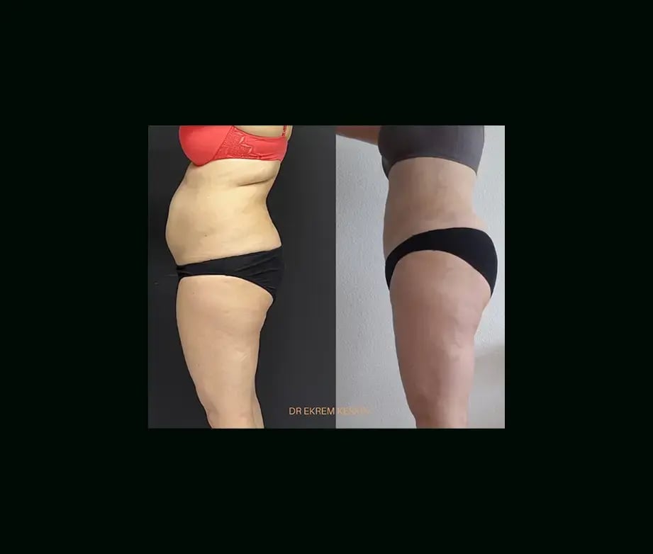 ekrem-keskin-md-liposuction-before-after-3-1