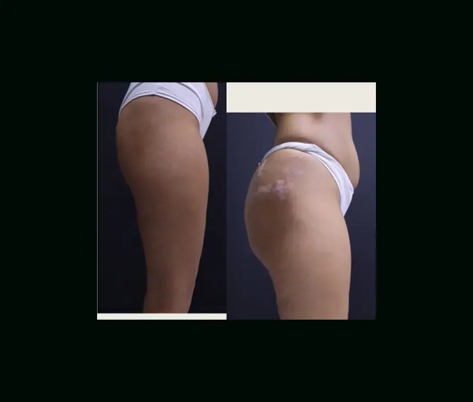 ekrem-keskin-md-non-surgical-butt-lift-before-after-2-2