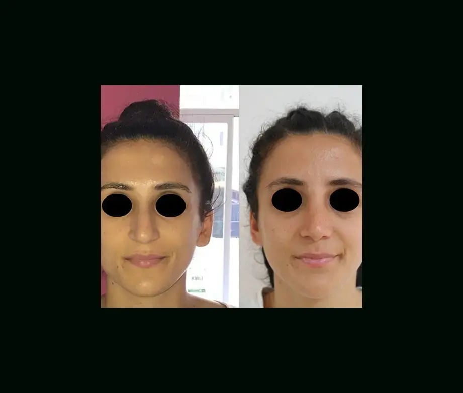 ekrem-keskin-md-rhinoplasty-before-after-1