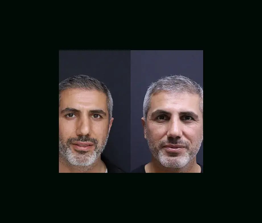 ekrem-keskin-md-rhinoplasty-before-after-2