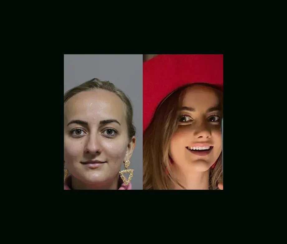 ekrem-keskin-md-rhinoplasty-before-after-3-1