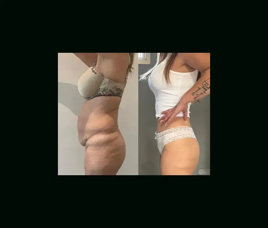 ekrem-keskin-md-tummy-tuck-before-after-2-2