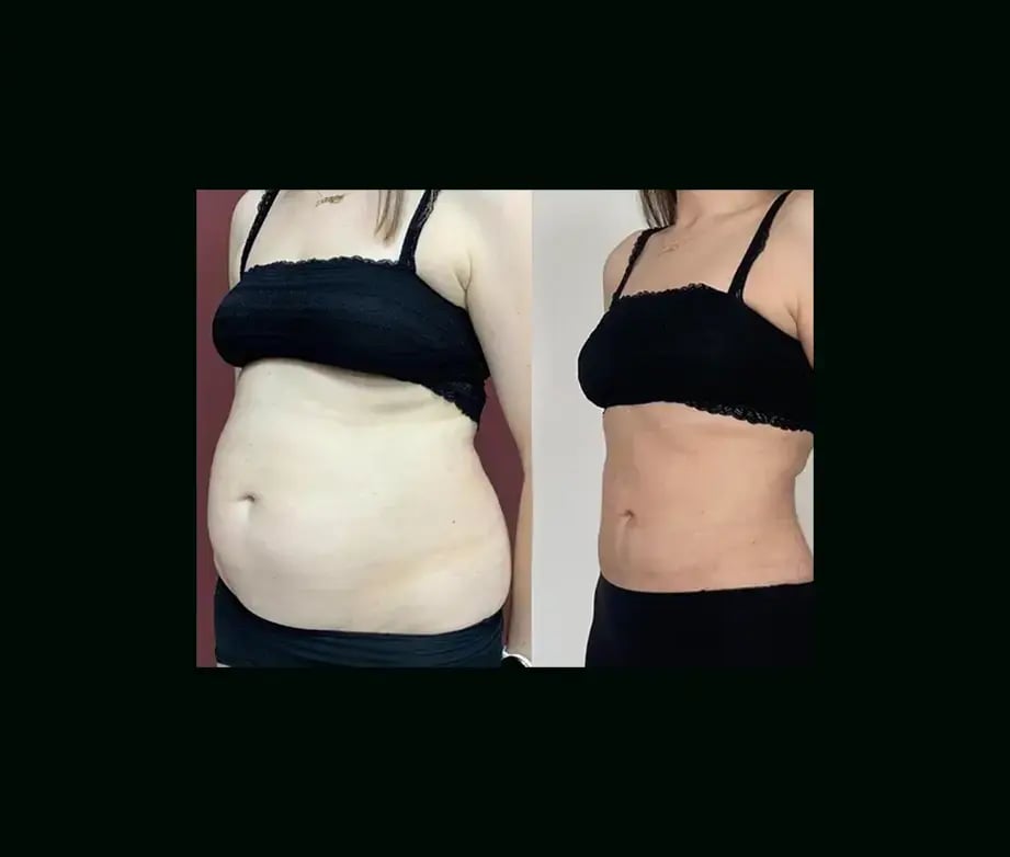 ekrem-keskin-md-tummy-tuck-before-after-3-2