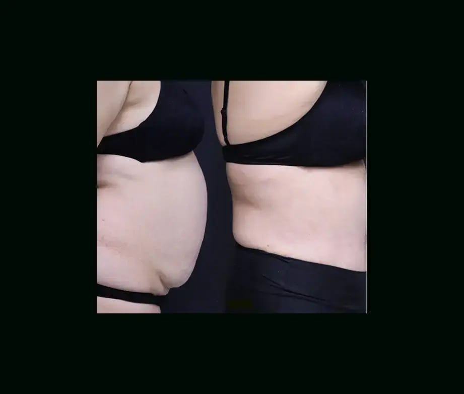 ekrem-keskin-md-tummy-tuck-before-after-4-2