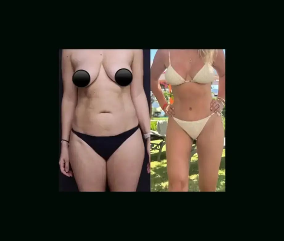 ekrem-keskin-md-tummy-tuck-before-after-5-1