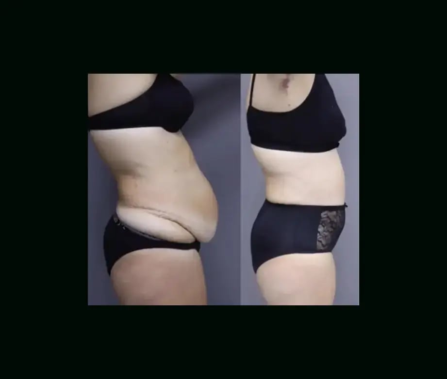 ekrem-keskin-md-tummy-tuck-before-after-6-2