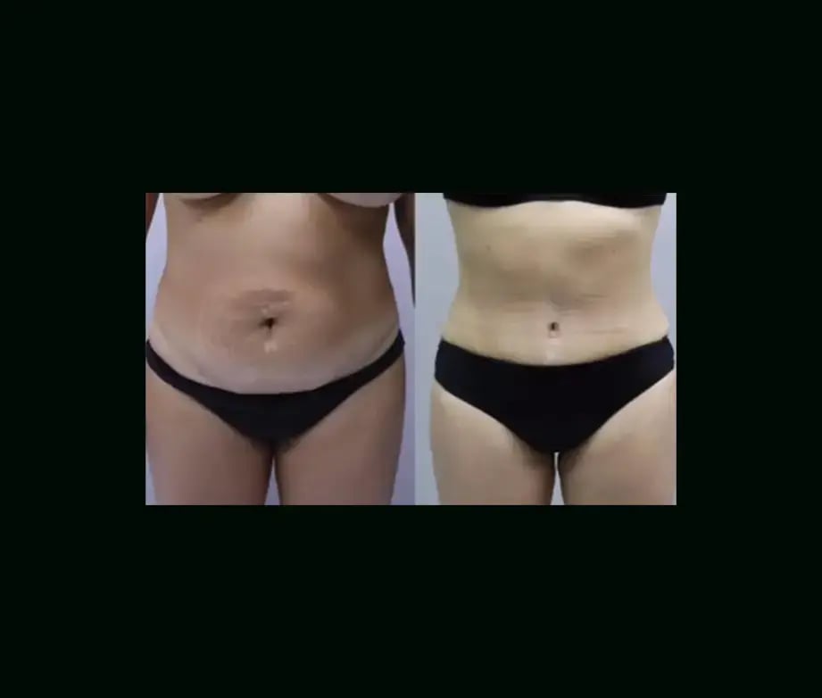 ekrem-keskin-md-tummy-tuck-before-after-7-2